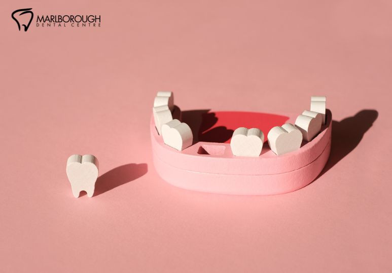 How Dental Implants Prevent Jawbone Loss